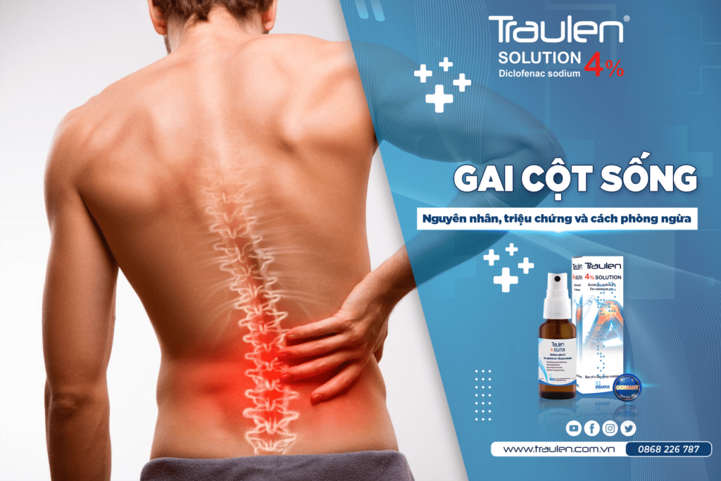 Gai cột sống: Nguyên nhân, triệu chứng và cách phòng ngừa 32 gai cot song