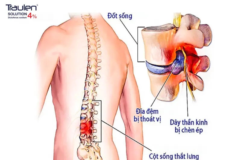 Thoát vị đĩa đệm cột sống thắt lưng