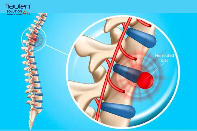 thoát vị đĩa đệm cột sống thắt lưng