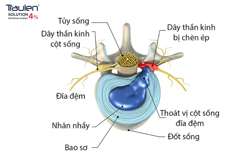 Thoát vị đĩa đệm cột sống thắt lưng