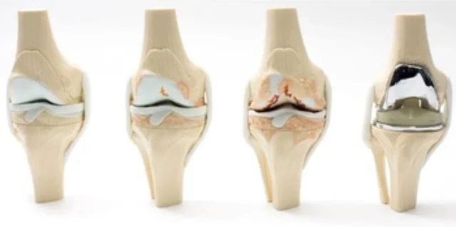 Phân độ thoái hóa khớp gối và những lưu ý điều trị ở từng giai đoạn 2 thoai hoa khop goi 1