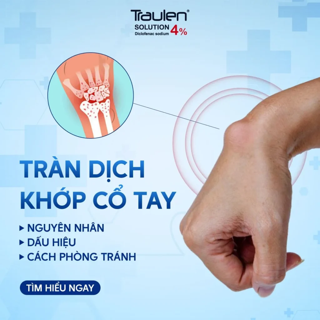 Tràn dịch khớp cổ tay: Nguyên nhân, dấu hiệu & cách phòng tránh 4 tran dich khop co tay 1