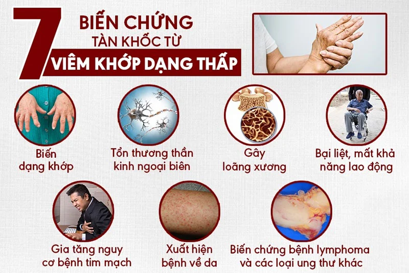 Tràn dịch khớp cổ tay: Nguyên nhân, dấu hiệu & cách phòng tránh 6 Viêm khớp dạng thấp có thể gây tràn dịch khớp cổ tay, làm mất khả năng vận động của khớp và biến dạng khớp
