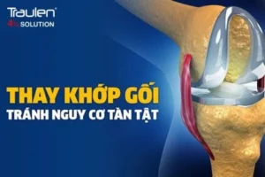 khop goi nhan tao
