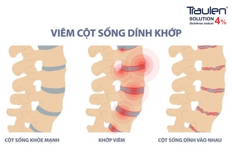 Tham khảo các lựa chọn điều trị viêm cột sống dính khớp hiện nay 4 Viêm cột sống dính khớp gây đau cột sống thắt lưng và viêm các khớp chi dưới