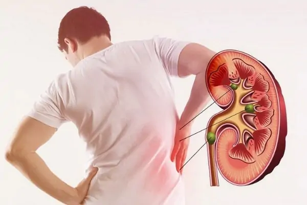 Diclofenac cho người cao tuổi - Hướng dẫn an toàn và hiệu quả dựa trên bằng chứng khoa học 5 Biến chứng của suy giảm chức năng gan chính là suy thận
