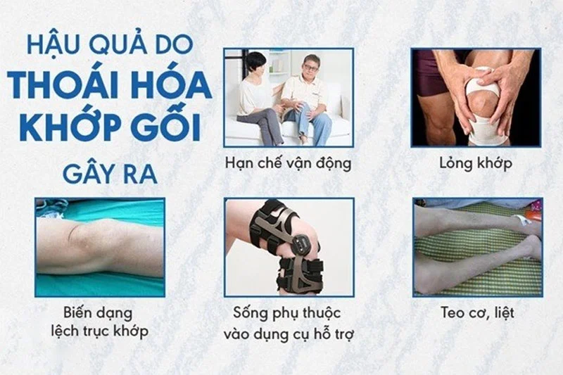 Tế bào gốc điều trị thoái hóa khớp gối: Giải pháp tiên phong cho cuộc sống không đau từ y học tái tạo 5 Thoái hóa khớp gối là tình trạng sụn khớp bị bào mòn dần và biến đổi cấu trúc, dẫn đến hình thành các gai xương quanh khớp và cuối cùng gây biến dạng khớp gối